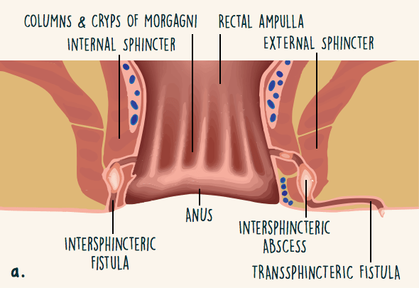 Cpt Code For Drainage Of Intersphincteric Abscess Best Drain Photos