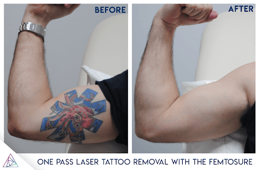 The Fastest Laser Tattoo Removal Laser Ever - The Femtosure Laser By Astanza 336_x_512_png