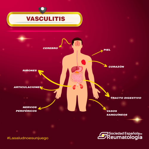 Vasculitis qué es, síntomas, diagnóstico y tratamiento