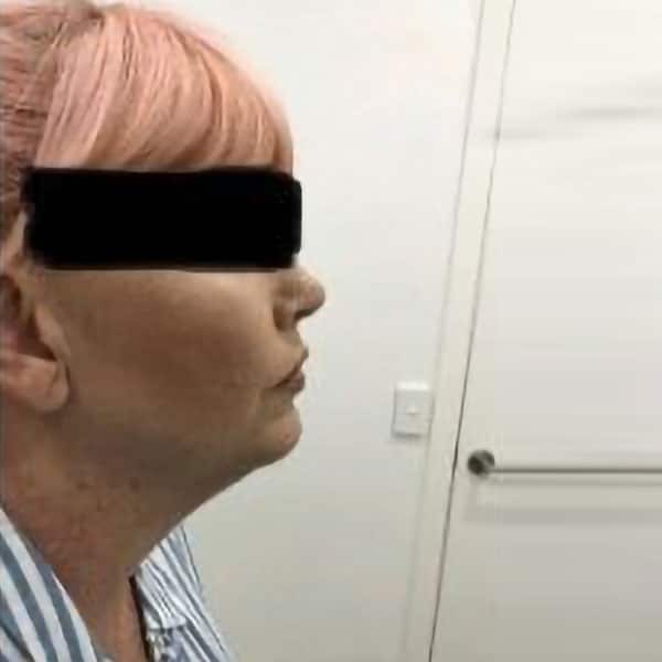 Fat Dissolving Injections in Brisbane Injex Clinics