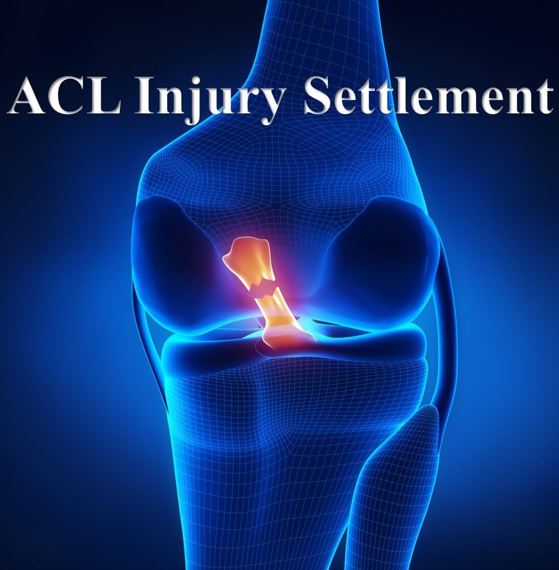 ACL Injury Settlements by Los Angeles Lawyer **(2021 Update)**