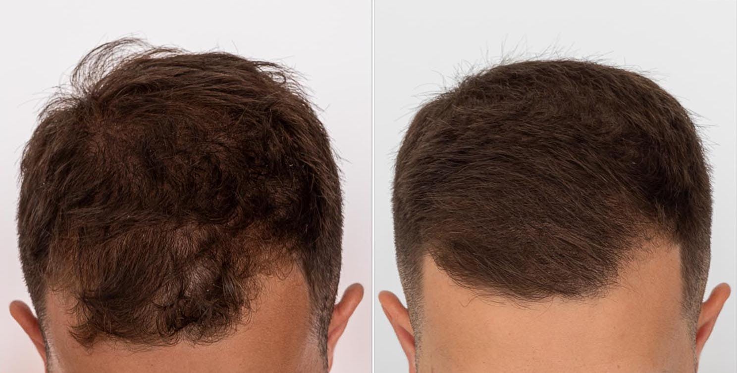 Rogaine Receding Hairline Before And After