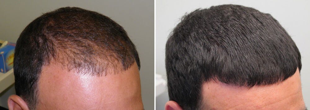 Finasteride Before and After Photos [2023]