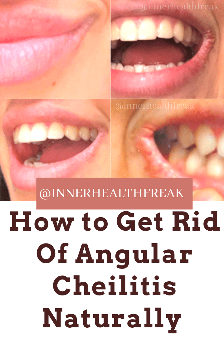 ANGULAR CHEILITIS REMEDY NATURAL Inner Health Freak