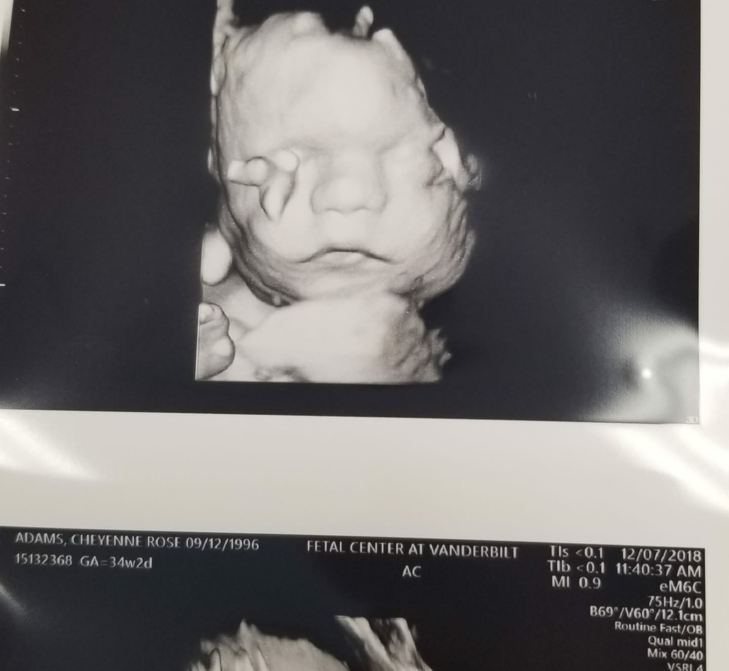 Newborn Diagnosed With Brittle Bone Disease Defies All Odds Inner