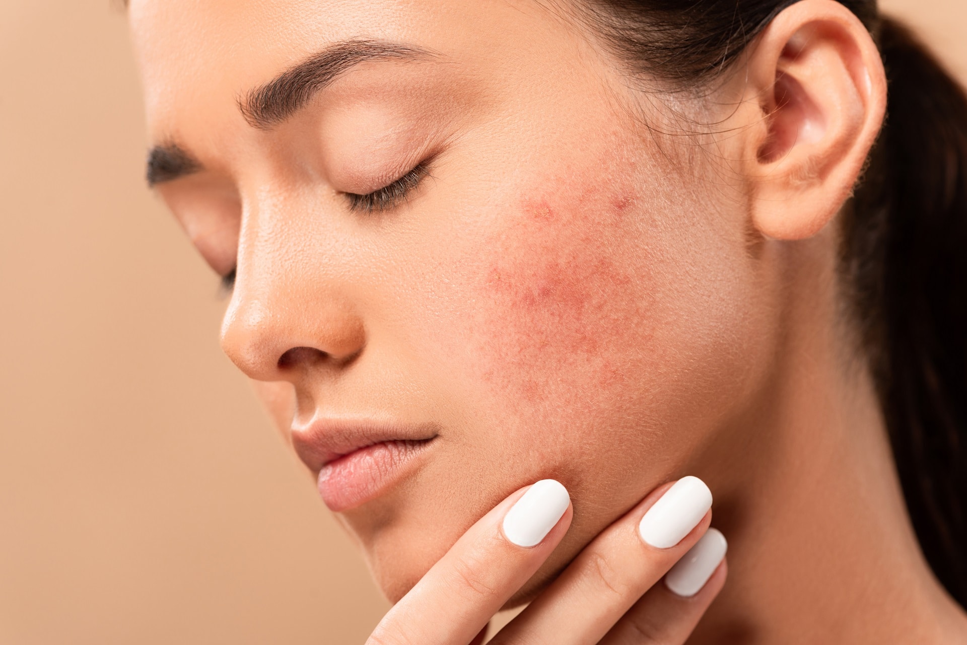 Acupuncture Treatment for Acne Inner Works Acupuncture