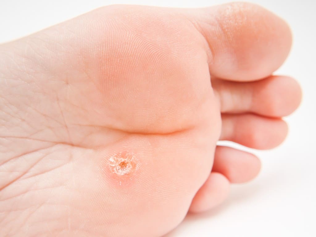 Warts Common Types and Best Treatment Methods