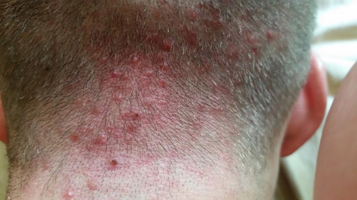 What is folliculitis, how to treat it and how it affects hair health
