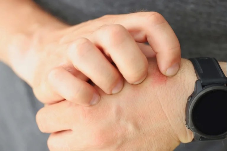 Why Does Scratching Mosquito Bites Feel Good Science Behind Itch Relief