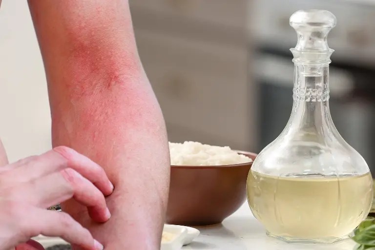 Why Does Vinegar Help Mosquito Bites Effective Remedies
