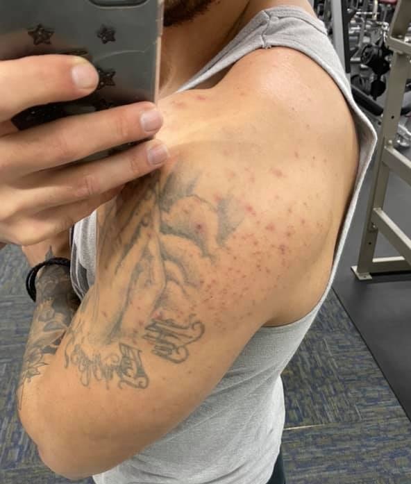 Top 15 Signs of SteroidUse (ScienceBased) Inside Bodybuilding