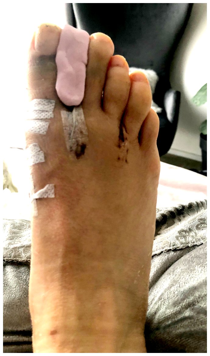 Bunion Surgery 2 Week PostOperation Update — Inside Out Style
