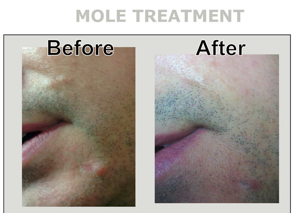 Mole Treatment/Removal at Inskin Altrincham, Manchester