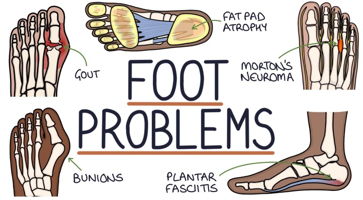 9 Common Foot Problems (Symptoms & Treatment) Insole Clinic