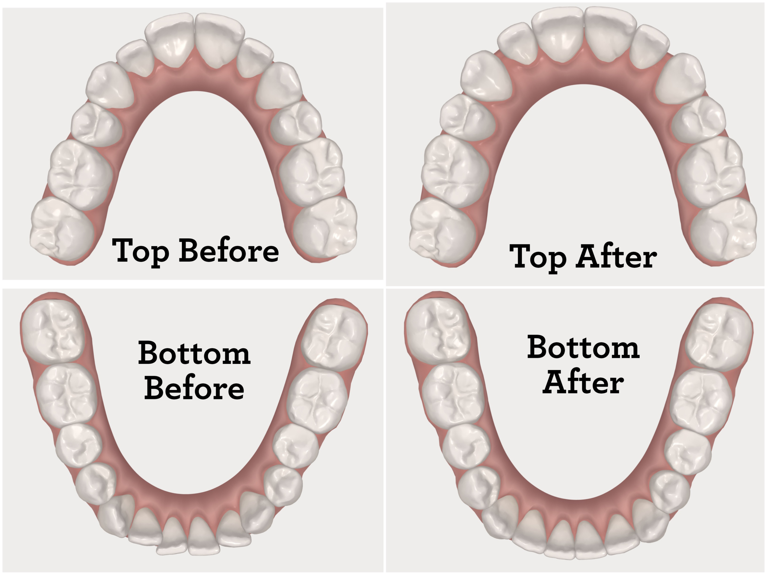 Invisalign Before And After Crossbite