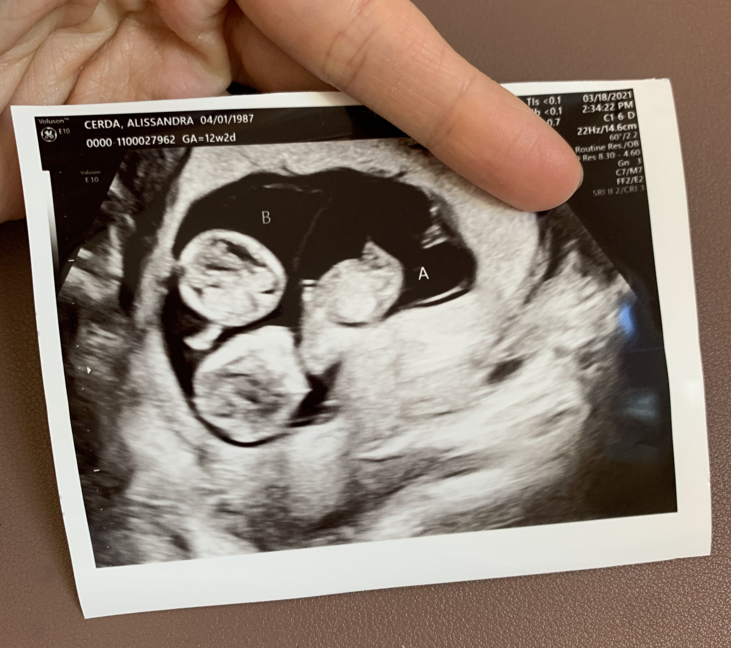 Identical Twins Ultrasound 7 Weeks