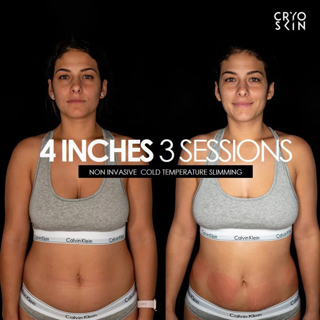 Cryoskin Body Contouring Cryoslimming treatment Burn Fat