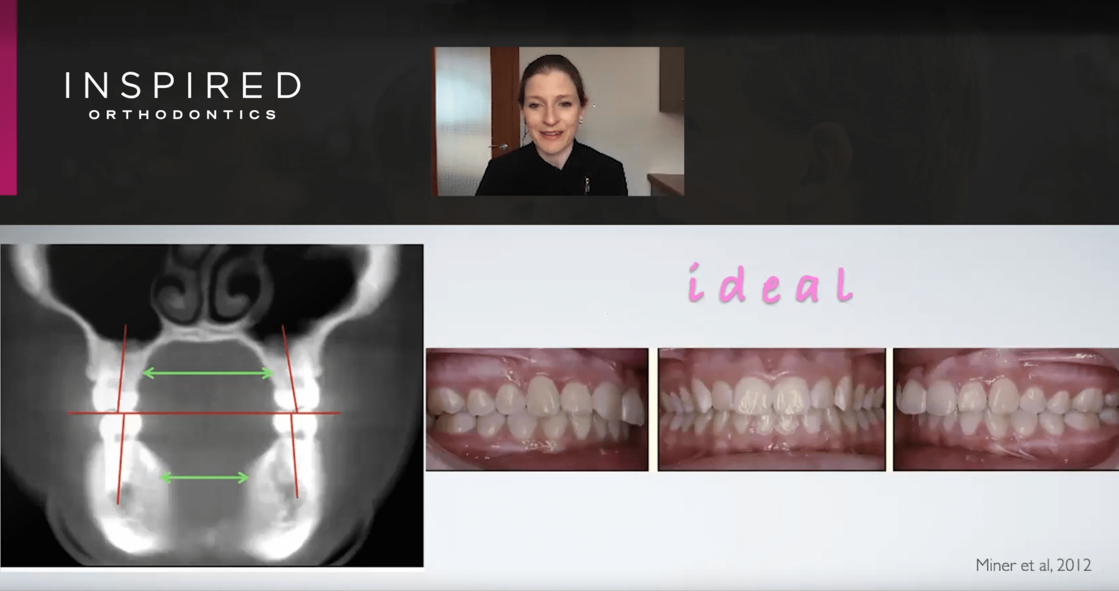 Considering Dental Arch Shape News Inspired Orthodontics Seattle