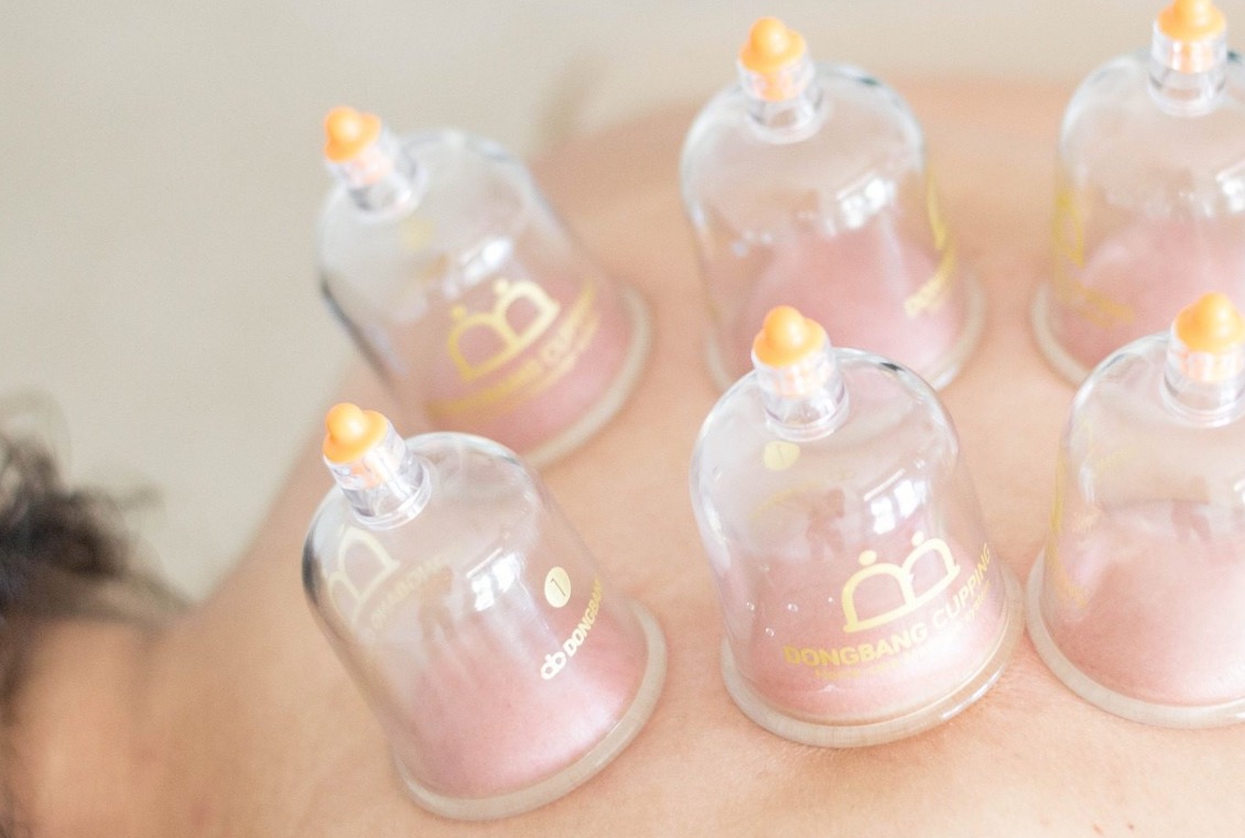 3 Ways Dry Cupping Can Help Physio Tooting And Balham Instant