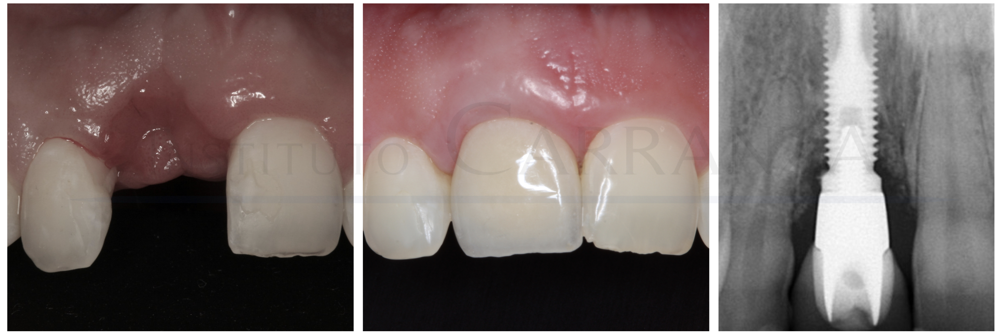 Regeneración de hueso para implantes complejos INSTITUTO CARRANZA