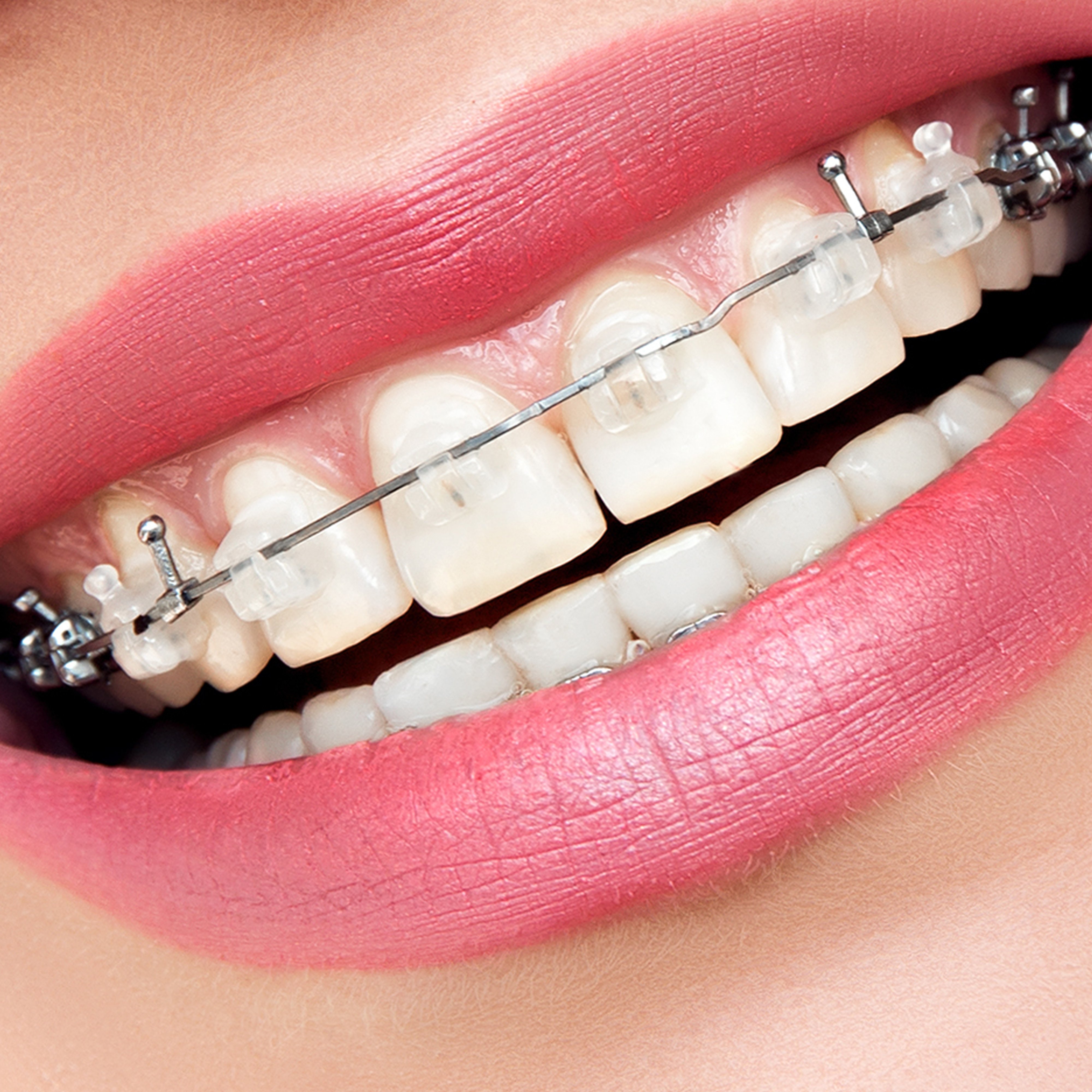 Ortodoncia Invisible (Invisalign). Ortodoncia convencional Archives