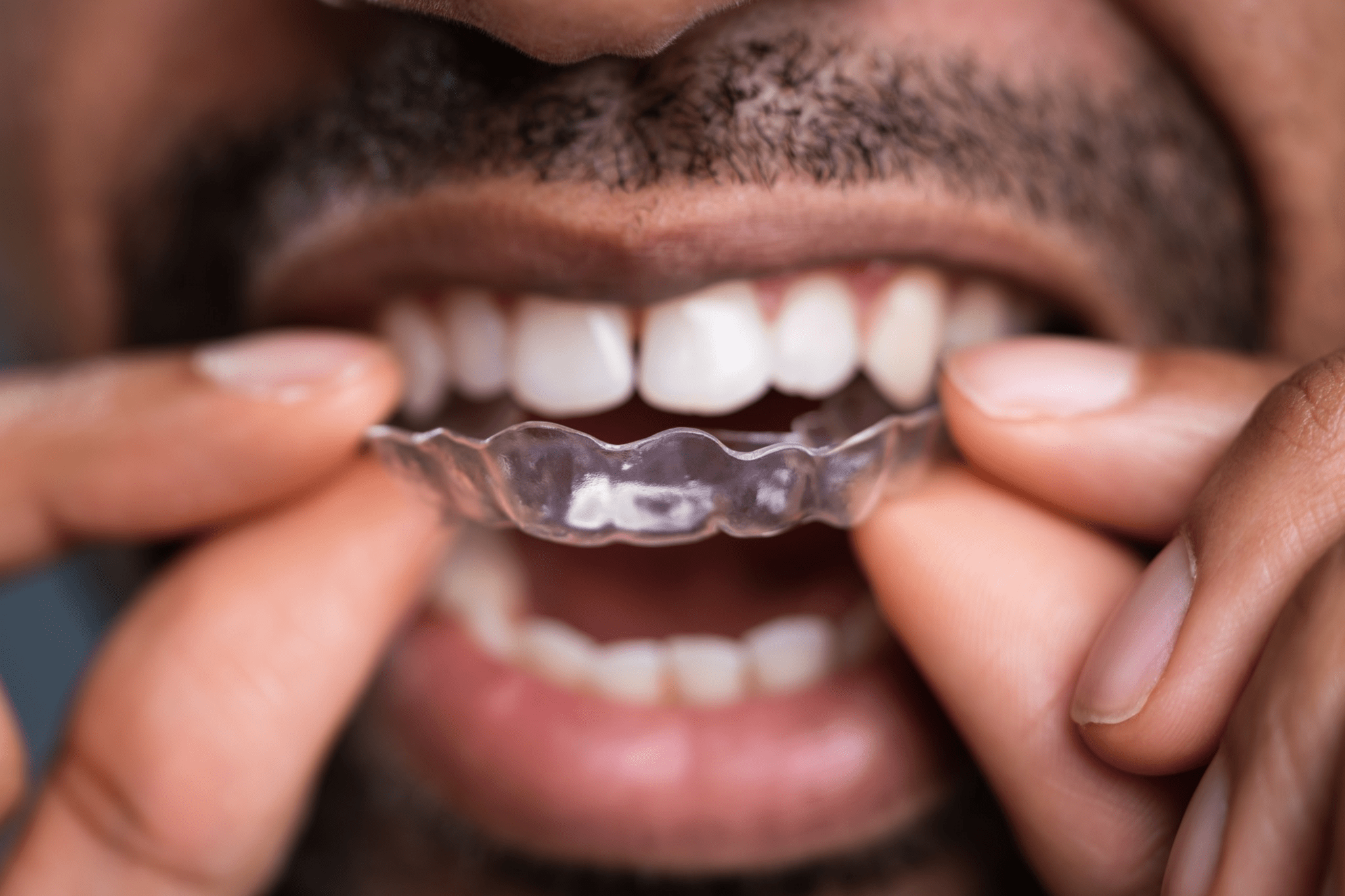 Benefits of Night Aligners