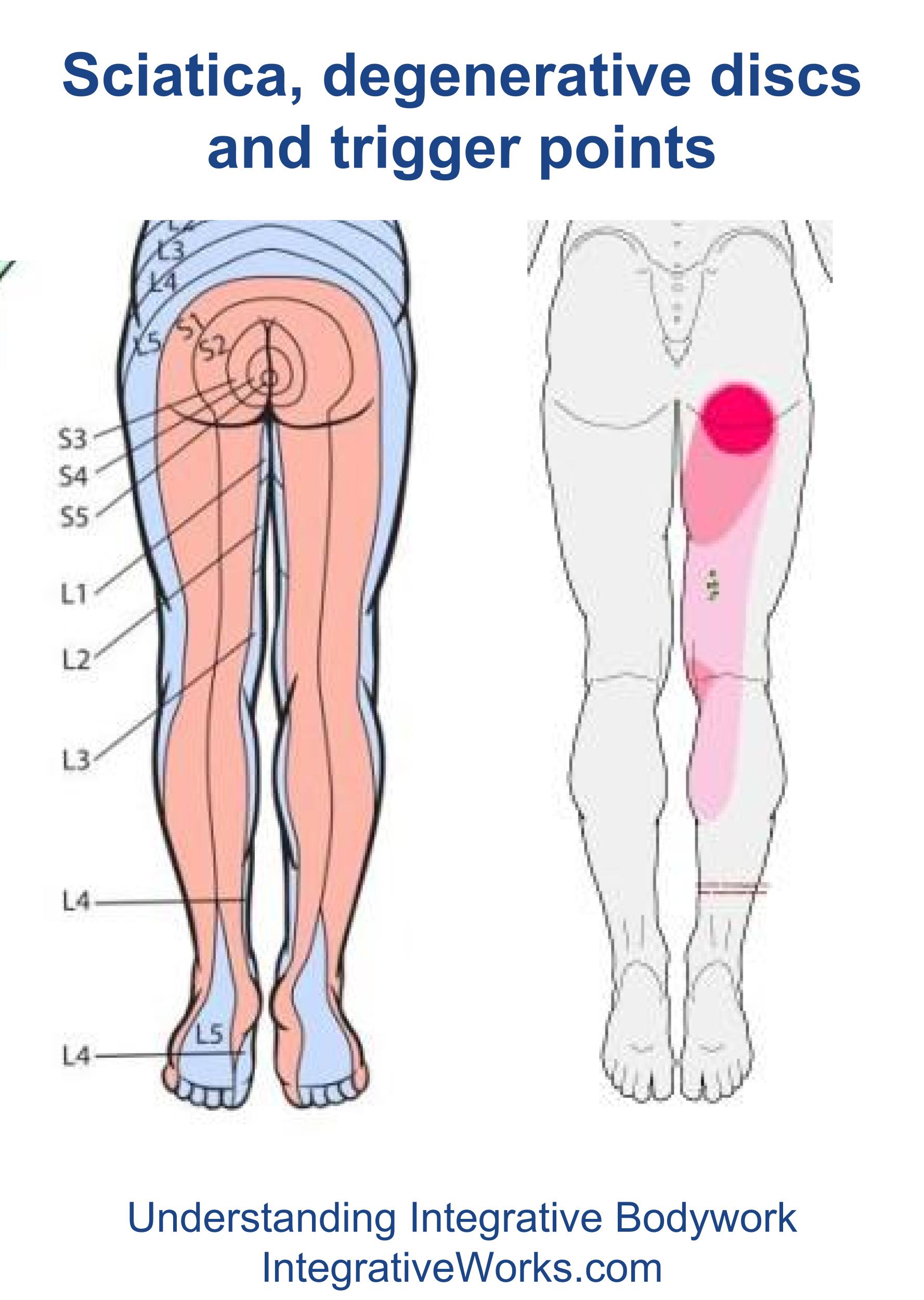 Sciatica, Degenerative Discs and Trigger Points Integrative Works