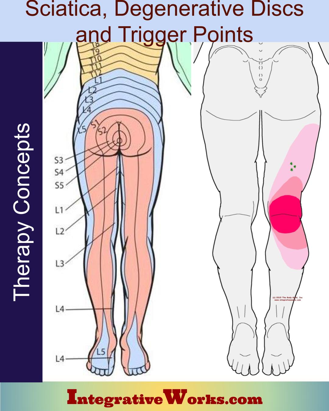 Sciatica, Degenerative Discs and Trigger Points Integrative Works