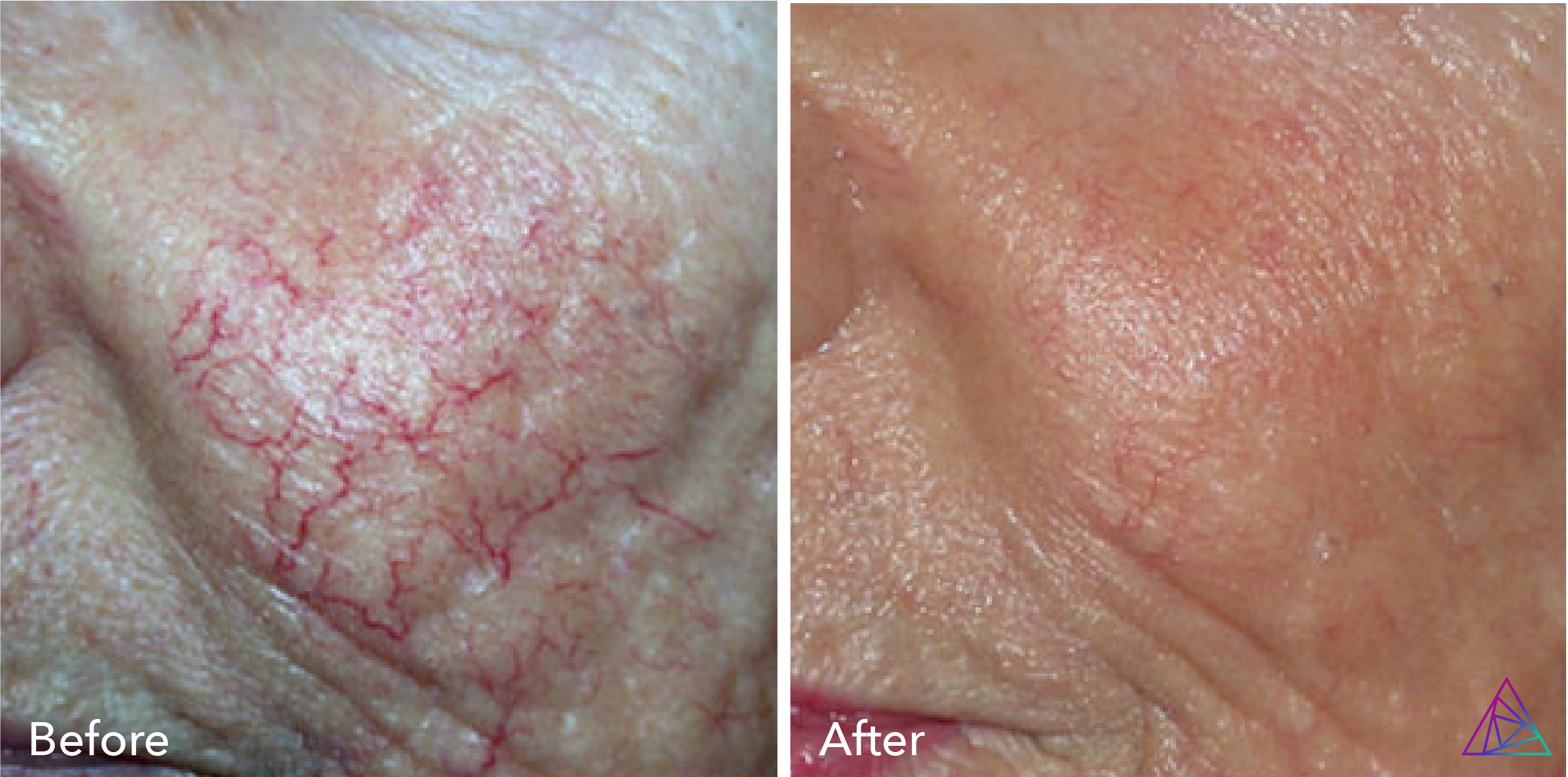 Vascular Lesion Removal Integrity Ink Tattoos & Tattoo Removal