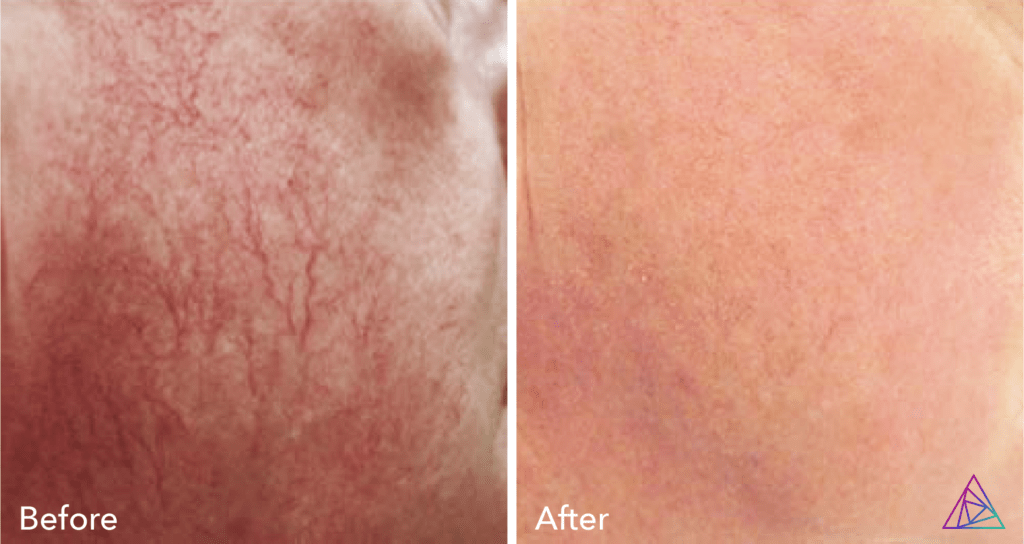 Vascular Lesion Removal Integrity Ink Tattoos & Tattoo Removal