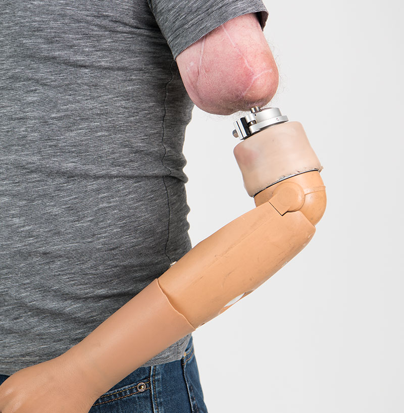 Transhumeral (AboveElbow) Amputations Integrum