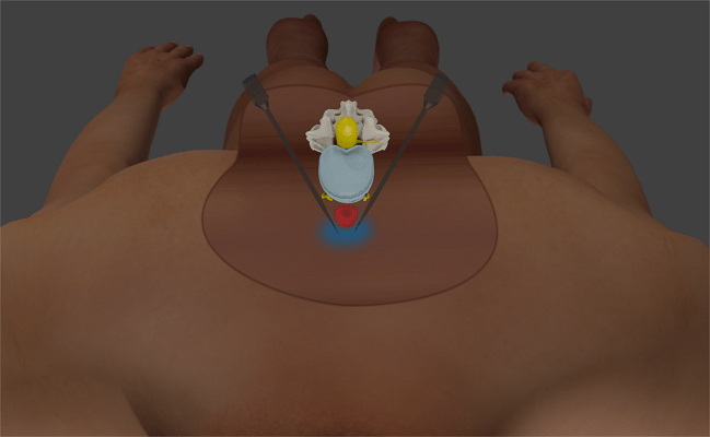 Lumbar Sympathetic Block Los Angeles & Beverly Hills CA IPS