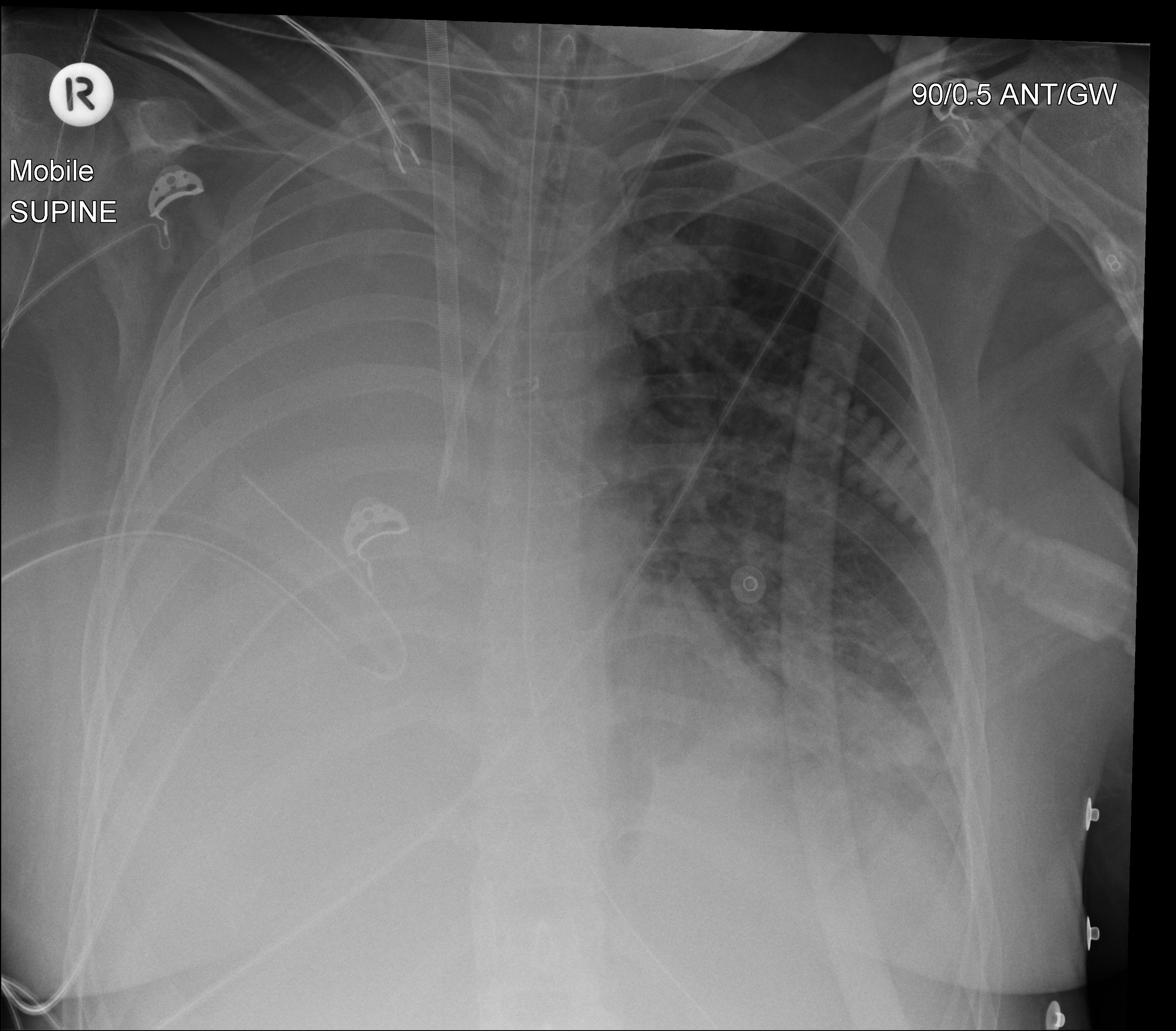 Bubbles aren't always a good thing INTENSIVE