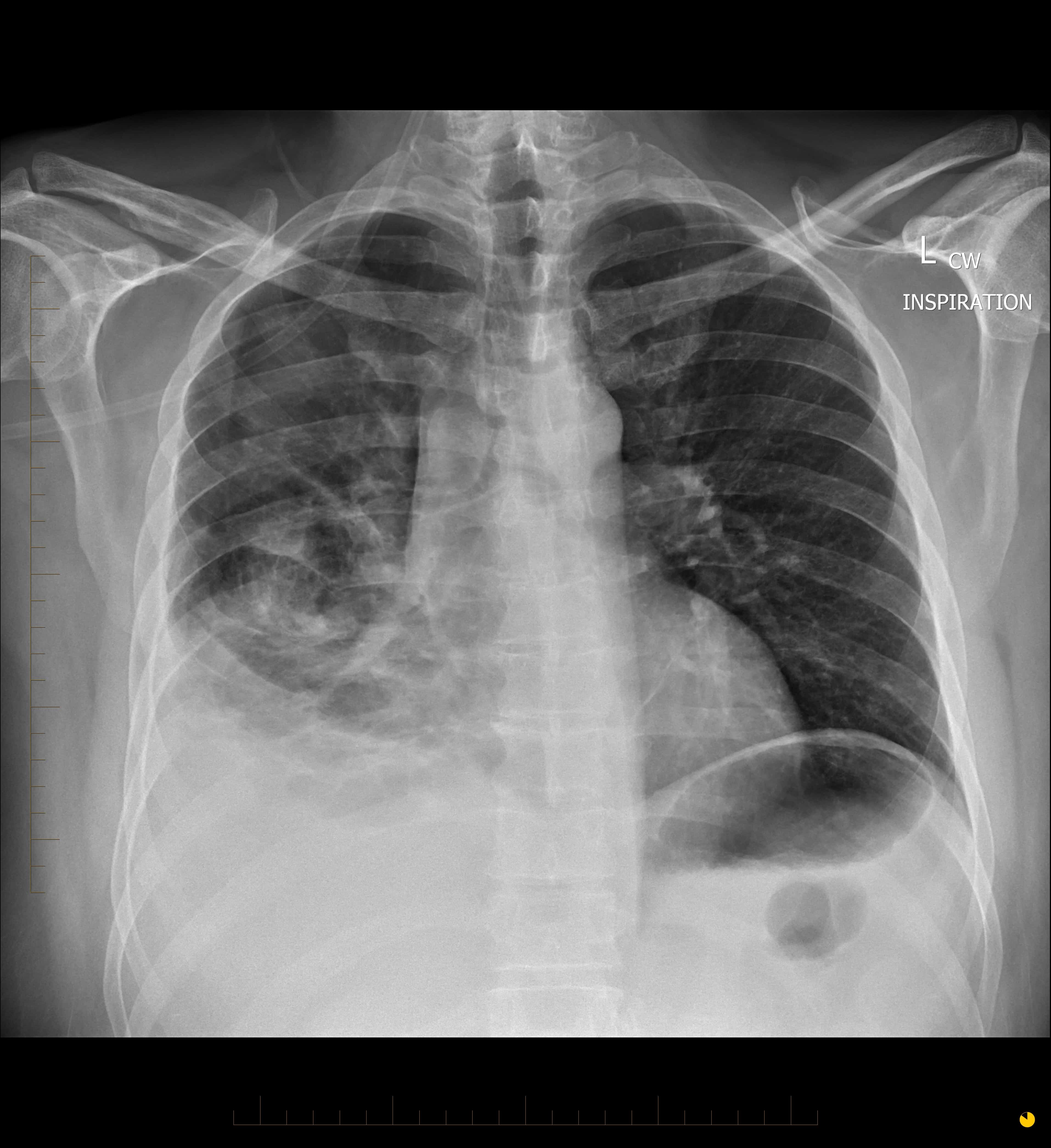 Chest X Ray Radiopedia