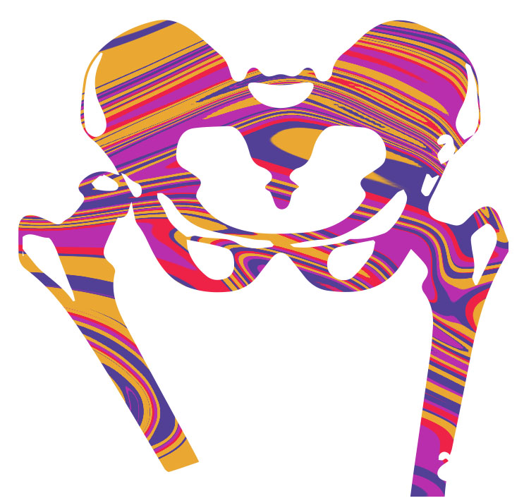 Hip Dysplasia Intercontinental Care