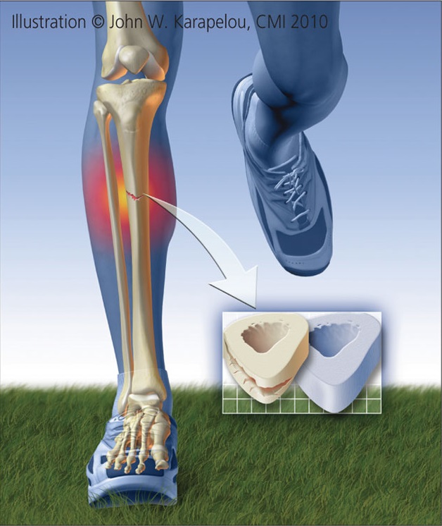 Running Stress Fracture Shin Symptoms