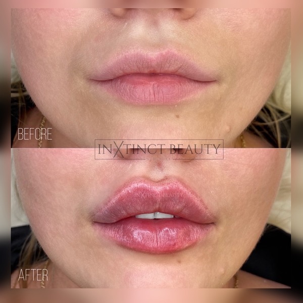 Russian Lip Filler Technique Before And After Before And After