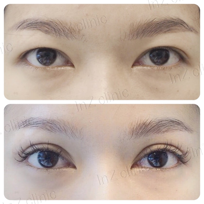 Current methods of double eyelid surgery, pros & cons inZ Clinic