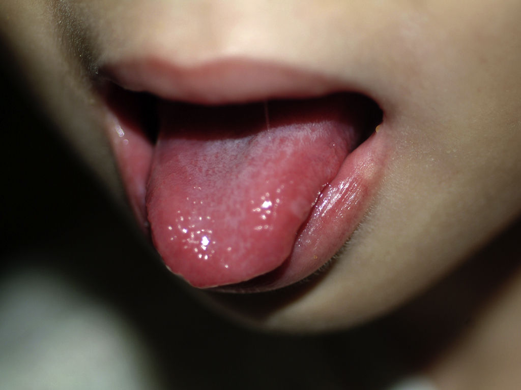 Estomatitis Herpética Infantil
