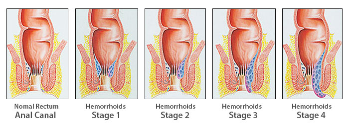 Haemorrhoid types and natural remedies