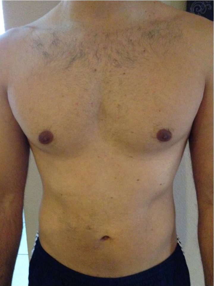 Laser hair removal Men • Waxing for men • IPL hair removal Montreal