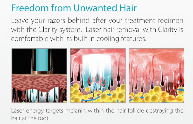 Laser Hair Removal Montreal, Permanent Hair Removal Women • IPL Lab