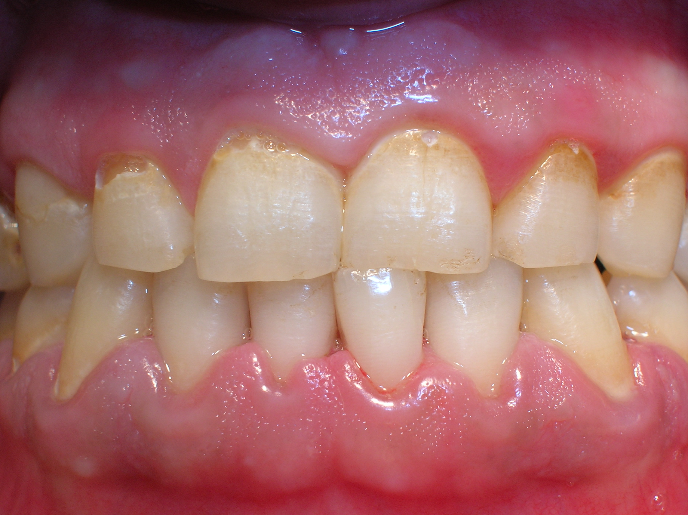 Placa supragingival y subgingival PERIODONCIA CICS