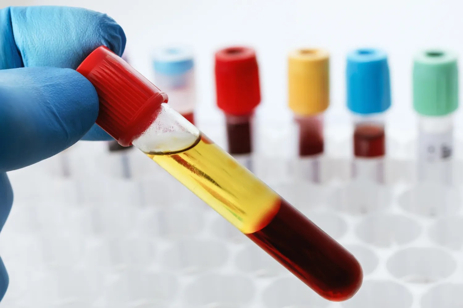 What Is the Difference Between Buffy Coat vs Pbmc iProcess
