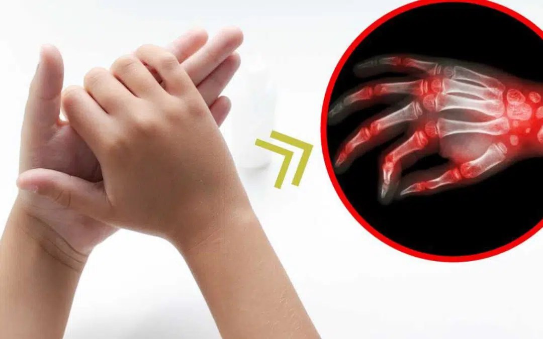 Artritis reumatoide juvenil IPS Cines