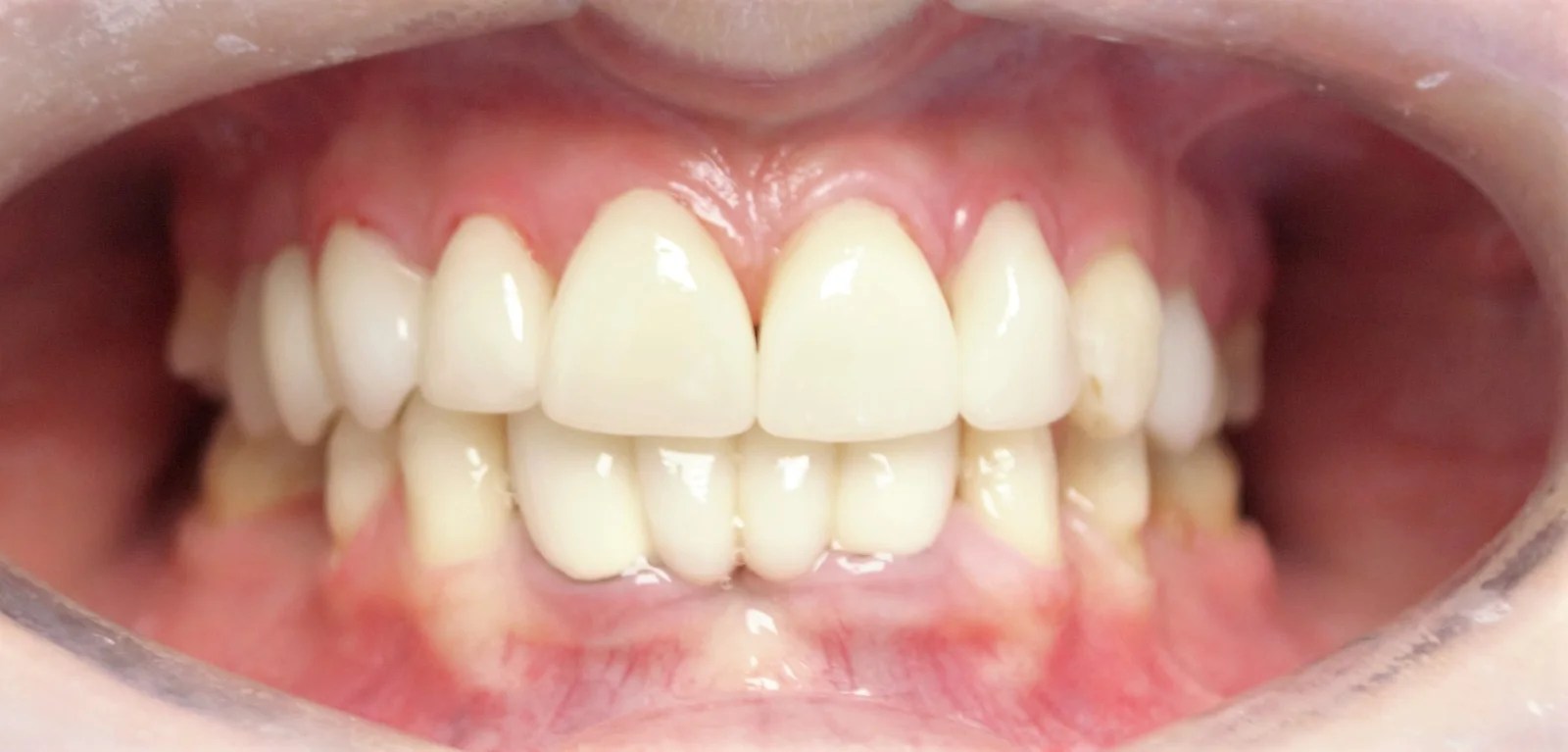 Veneers Ipswich Ipswich Dental Surgery Porcelain, Composite Veneers