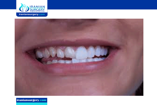 Dental Veneers Price Philippines The Door Knockers