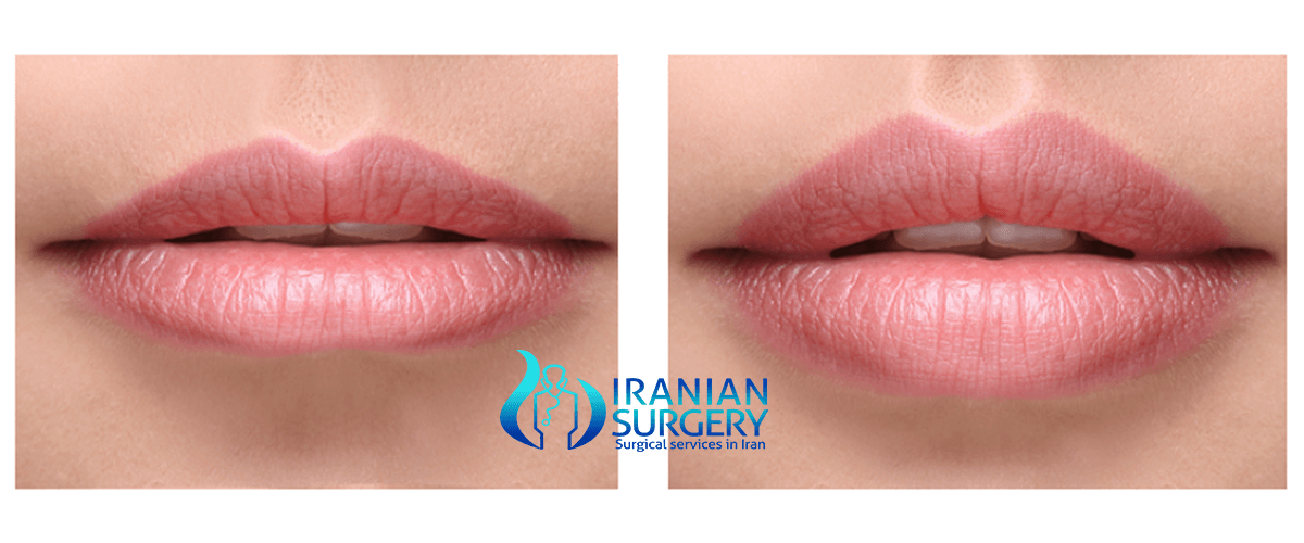 Lip augmentation Iranian Surgery