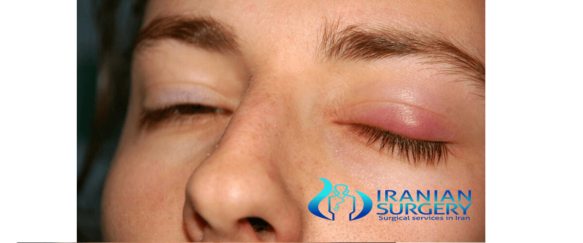 chalazion surgery recovery time Captions Definition