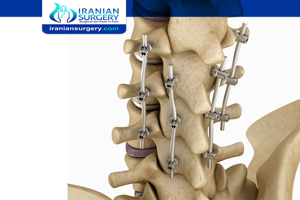 spinal fusion surgery cost bone fusion spinal fusion surgery